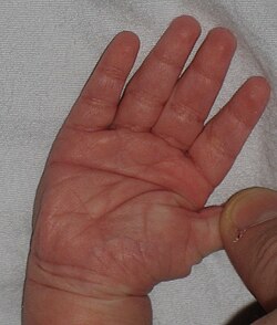 รอยพับฝ่ามือตามขวางเดี่ยว