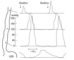 Esophageal motility study