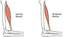 ซาร์โคพีเนีย