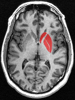 ภาพ MRI แสดงส่วนของสมองที่เรียกว่า สไตรเอตัม (striatum) ซึ่งประกอบด้วยนิวเคลียสคอเดต (caudate nucleus) และนิวเคลียสเลนติฟอร์ม (lentiform nucleus) ซึ่งรวมถึงพูตาเมน (putamen) และโกลบัสพัลลิดัส (globus pallidus)