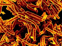Urogenital tuberculosis