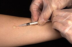 การทดสอบ Mantoux
